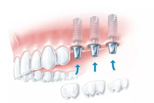 Conventional Implantation