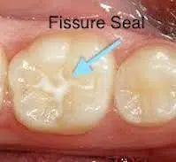 fissure sealant