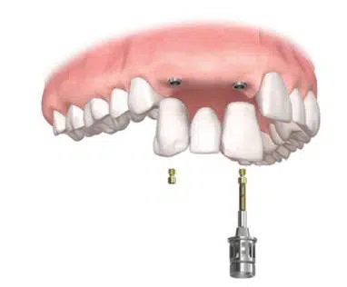 Mini Implant