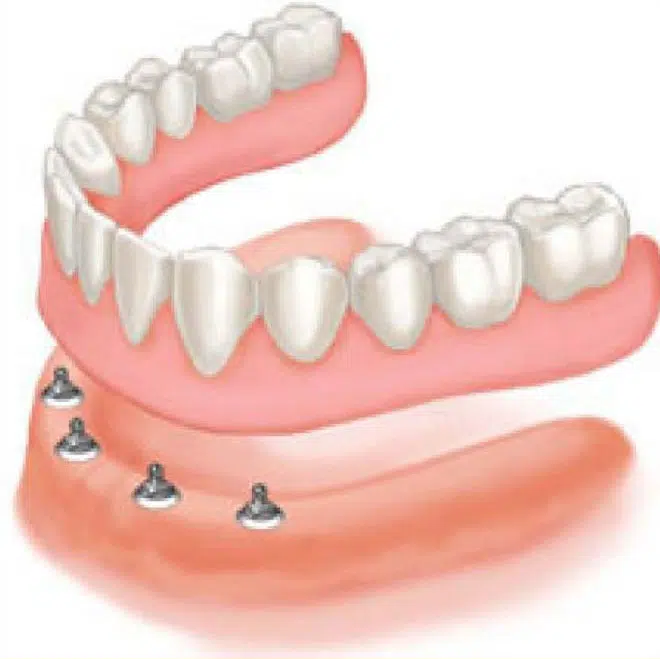 Implant Support Dentures