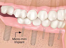 Mini Implant